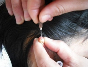 高血压急救的正确方法放血,高血压的中医急救方案