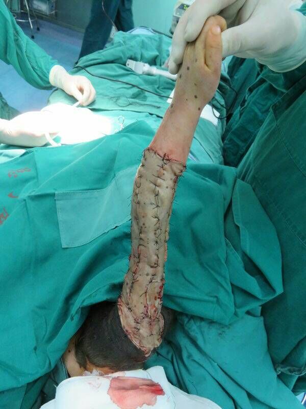 儿童切除黑痣需要全麻吗,先天性巨型兽皮痣能治愈吗