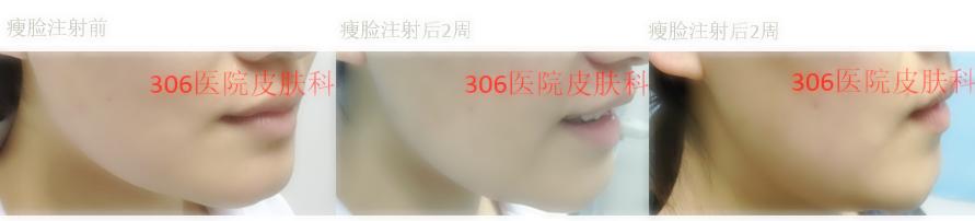 国家认可瘦脸针,军医扎针