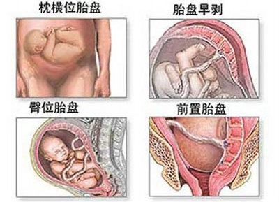 剖宫产分娩选择,剖腹产和顺产到底该如何选择