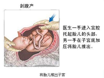 剖宫产分娩选择,剖腹产和顺产到底该如何选择