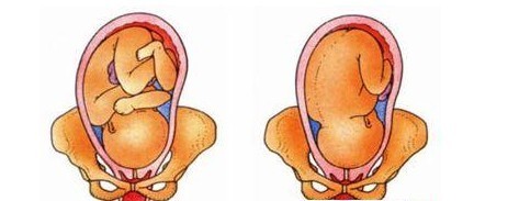 孕期尿床别忽视,产前尿失禁怎么回事