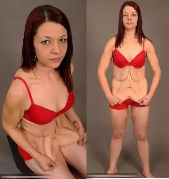 减肥后肚子皮肤松弛大概多久恢复,减肥后脸部皮肤松弛能自己恢复吗