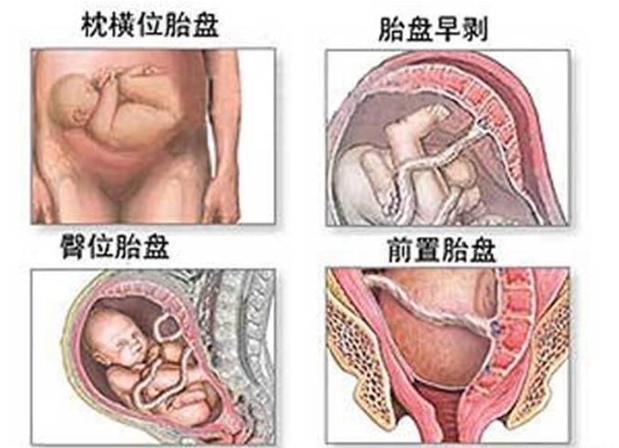 经历了剖腹产才知道妈妈的不容易,看完剖宫产过程你就会明白