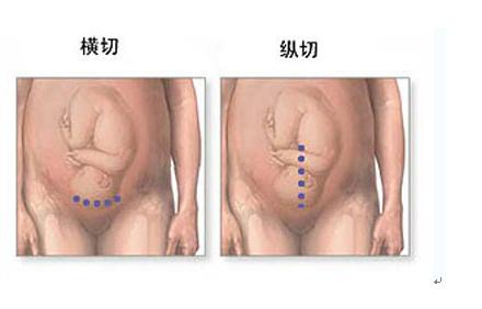 经历了剖腹产才知道妈妈的不容易,看完剖宫产过程你就会明白