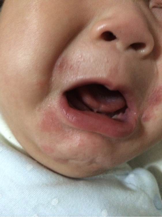 6个月宝宝嘴边眼睛周围有湿疹,6个月的宝宝嘴边起湿疹怎么办