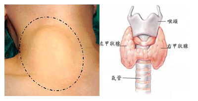 甲亢患者禁吃一览表,甲亢病人严禁吃哪些食品