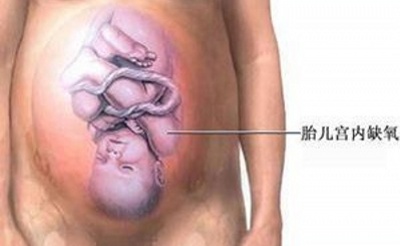 剖宫产分娩选择,剖腹产和顺产到底该如何选择