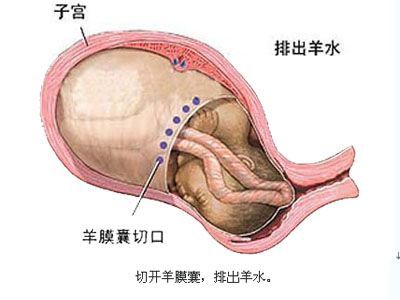 剖宫产分娩选择,剖腹产和顺产到底该如何选择