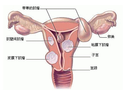 从病因、症状到治疗方法，你想知道的子宫肌瘤知识都在这里啦！