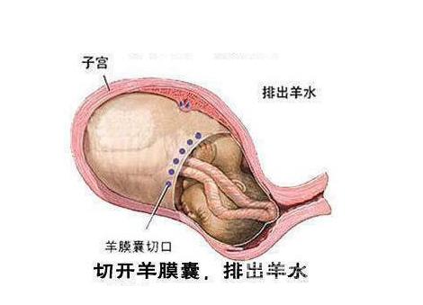 经历了剖腹产才知道妈妈的不容易,看完剖宫产过程你就会明白