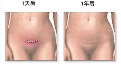 经历了剖腹产才知道妈妈的不容易,看完剖宫产过程你就会明白