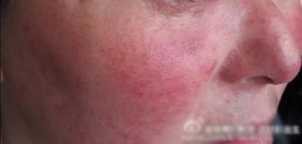 酒渣鼻怎么改善学生党,酒渣鼻严重怎么彻底治疗