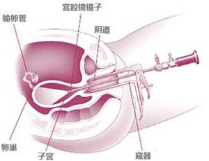 「又是“人流”惹的祸」发生子宫粘连怎么破?
