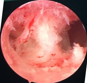 「又是“人流”惹的祸」发生子宫粘连怎么破?