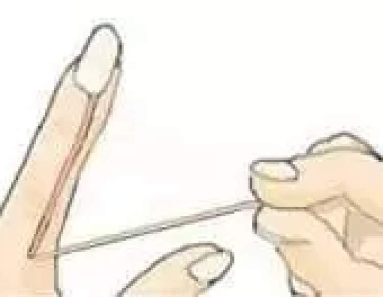 12.25|周到晨报：女白领随手撕倒刺感染，手指肿成萝卜！看完你还敢手欠吗？