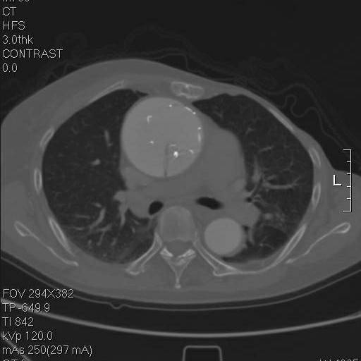 主动脉夹层早期征兆35岁,主动脉夹层早期征兆心率