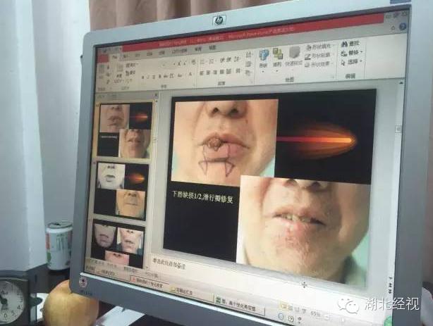 嘴唇肿块是癌症的前兆,嘴唇旁边长一个肿瘤怎么办