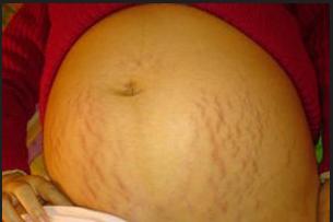 妊娠纹怎么消除最快最有效的办法,妊娠纹公认最好的方法去除