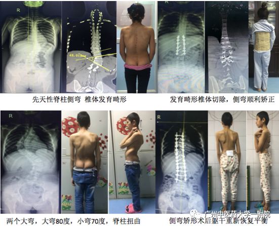 脊柱侧弯属于严重残疾吗,儿童脊柱侧弯去哪个医院好