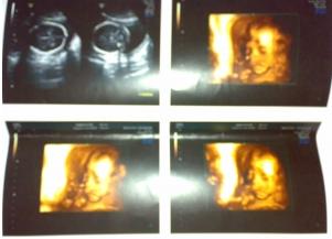 超准!轻轻松松看胎儿“性别”,准妈妈需学习一下这简单方法