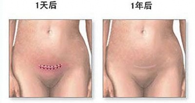 剖宫产分娩选择,剖腹产和顺产到底该如何选择