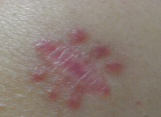 皮肤痣哪些不能要,身体有好多痣要不要处理