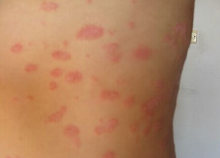 皮肤痣哪些不能要,身体有好多痣要不要处理