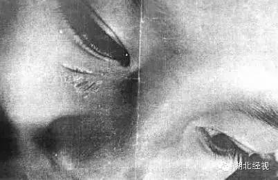 5岁男童被毁容,小孩被雨伞划伤