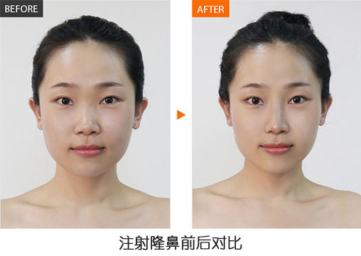 打玻尿酸的明星,为什么明星都要打玻尿酸