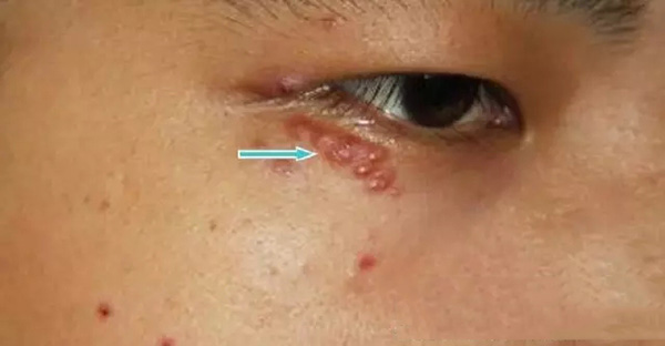 酒渣鼻怎么改善学生党,酒渣鼻严重怎么彻底治疗