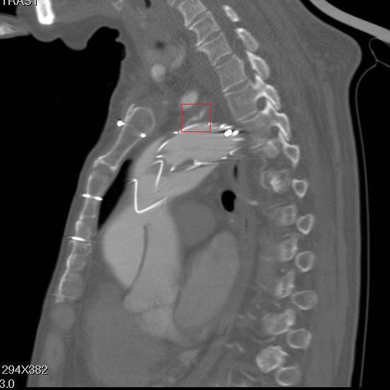 主动脉夹层早期征兆35岁,主动脉夹层早期征兆心率