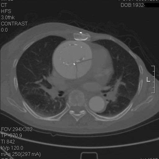 主动脉夹层早期征兆35岁,主动脉夹层早期征兆心率