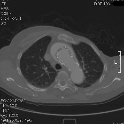 主动脉夹层早期征兆35岁,主动脉夹层早期征兆心率