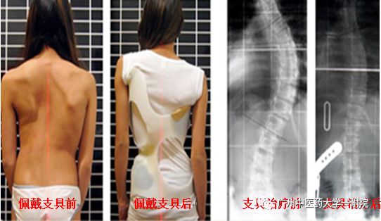 脊柱侧弯属于严重残疾吗,儿童脊柱侧弯去哪个医院好