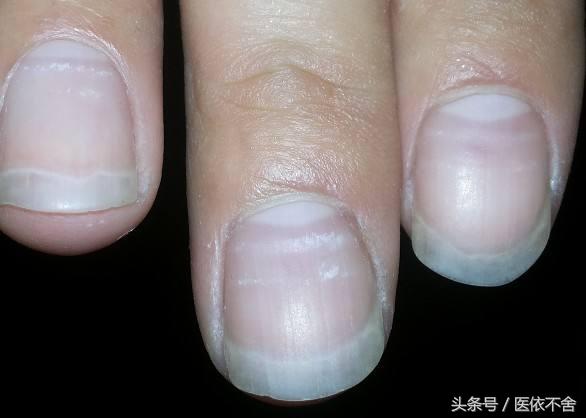 指甲异常色,甲沟炎拔了指甲长出来是灰色指甲