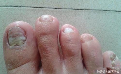 指甲异常色,甲沟炎拔了指甲长出来是灰色指甲