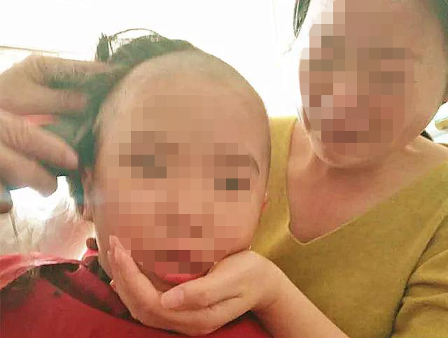 为治头皮型银屑病，小女孩剃光头，这下真的好了！