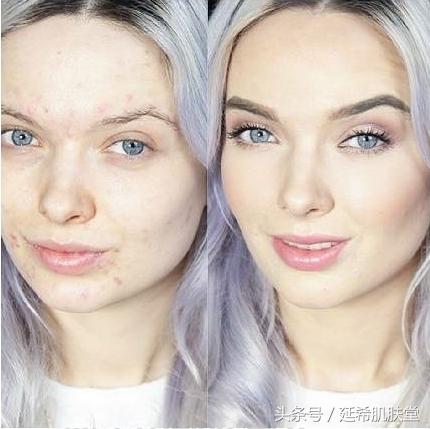 “你如果不长痘一定很好看”——长痘患者的自述