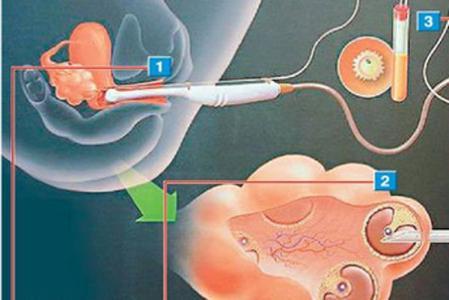 真实试管婴儿的过程,试管婴儿的真实过程
