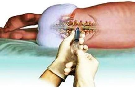 腰椎间盘突出的症状有哪些表现,独活寄生汤治腰椎间盘突出案例