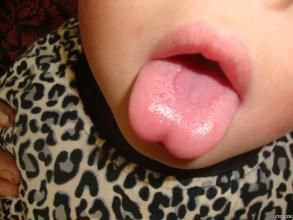 宝宝地图舌反复发作怎么回事,地图舌是缺锌还是缺维生素b