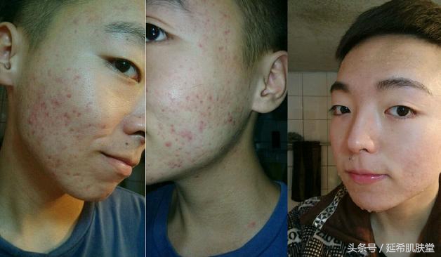 “你如果不长痘一定很好看”——长痘患者的自述