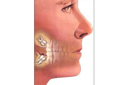 智齿发炎为什么不能拔牙,智齿发炎为什么不能割牙龈