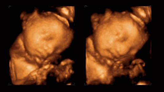 孕晚期不容易脐带绕颈,孕晚期脐带绕颈怎么样才能绕出来