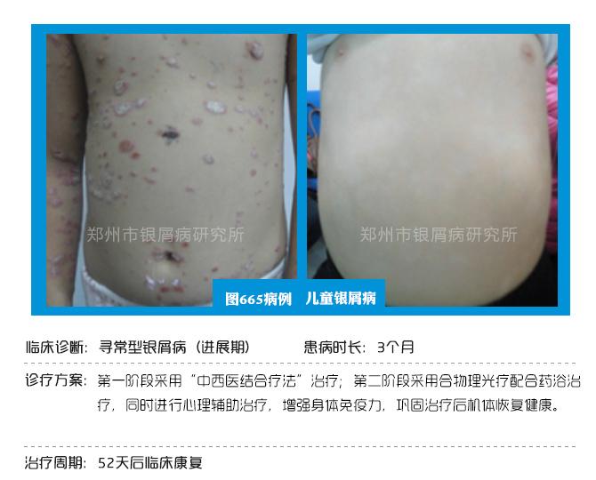 为治头皮型银屑病，小女孩剃光头，这下真的好了！