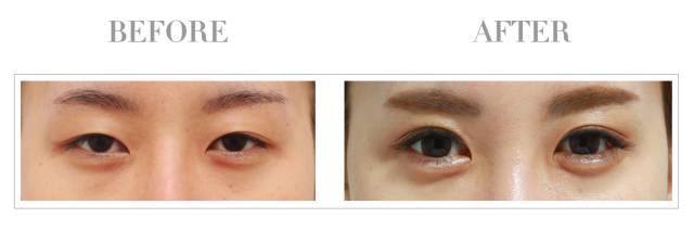 眼袋显老还是泪沟显老,40岁眼袋有泪沟怎么办