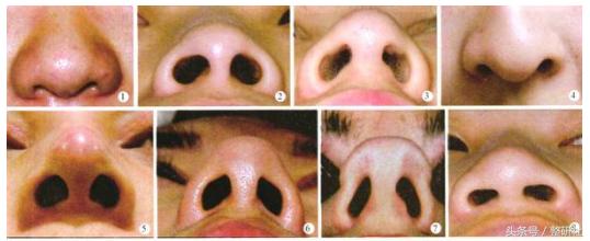 女生怎么逆袭蒜头鼻,女生通天鼻怎么修