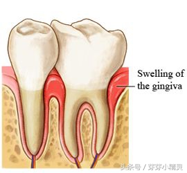 儿童换牙期牙周炎怎么治疗,儿童牙周炎怎么治疗效果最好