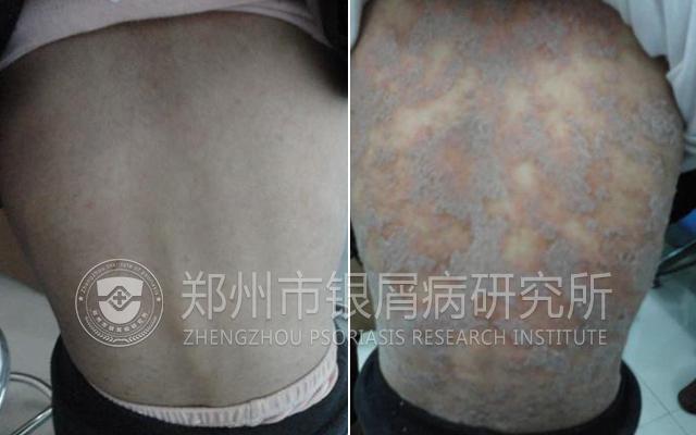 银屑病绝不能忌口,银屑病真的不能用激素么